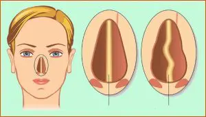 Ilustração comparativa do septo nasal normal e do septo nasal desviado, septoplastia