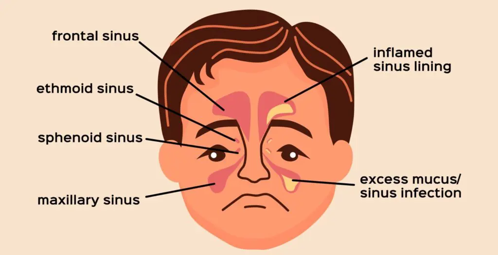 Ilustração dos seios paranasais e do procedimento de sinusectomia.