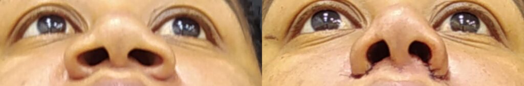 Resultados de procedimentos de plástica facial realizados pelo Dr. Gabriel Bijos