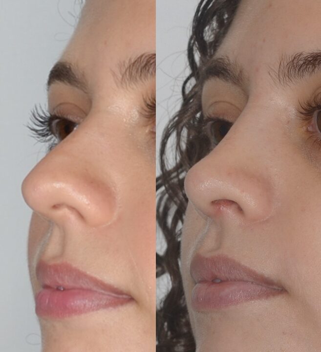 Comparação de antes e depois de uma rinoplastia realizada pelo Dr. Gabriel Bijos