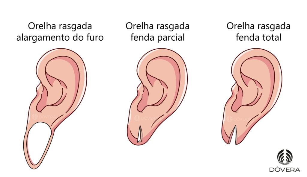 técnica de lobuloplastia