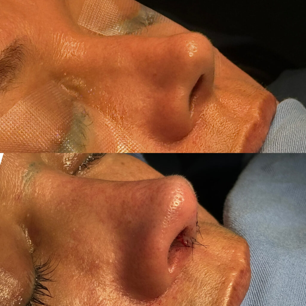 Antes e depois de uma cirurgia de rinoplastia realizada pelo Dr. Gabriel Bijos 3