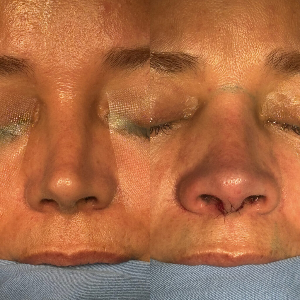 Antes e depois de uma cirurgia de rinoplastia realizada pelo Dr. Gabriel Bijos 2