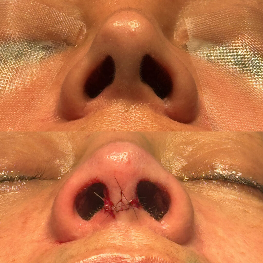 Antes e depois de uma cirurgia de rinoplastia realizada pelo Dr. Gabriel Bijos 5