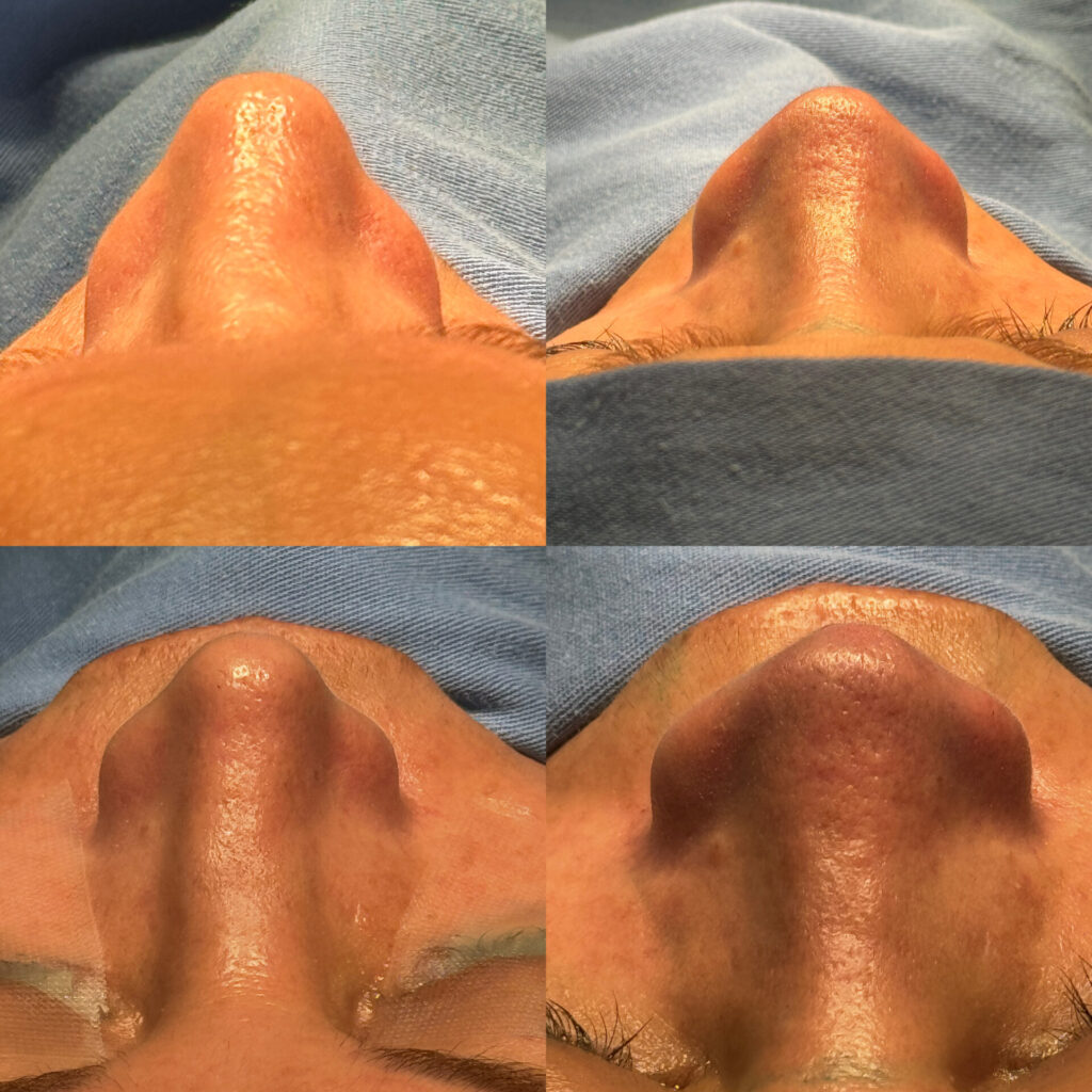 Antes e depois de uma cirurgia de rinoplastia realizada pelo Dr. Gabriel Bijos 6