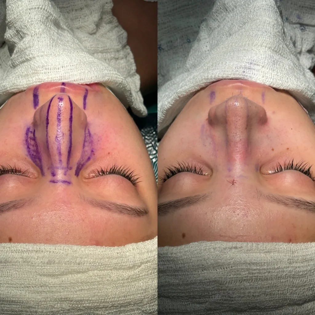 Resultados de antes e depois da rinoplastia em Salvador.